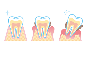 歯周病とは